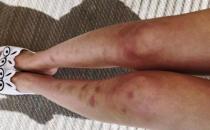 腿上有淤青是否真是被鬼掐的 有些淤青是血液病所致