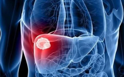 肝癌晚期的症状大揭秘 肝癌晚期手术切除是首选方案