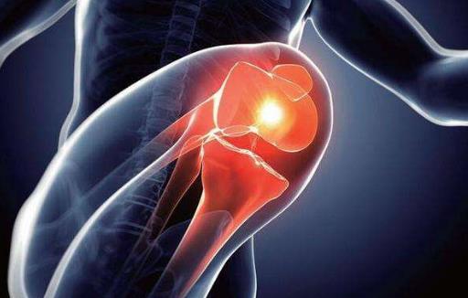 膝骨关节炎影响生活质量和运动能力 骨关节炎的预防