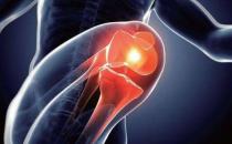 膝骨关节炎影响生活质量和运动能力 骨关节炎的预防