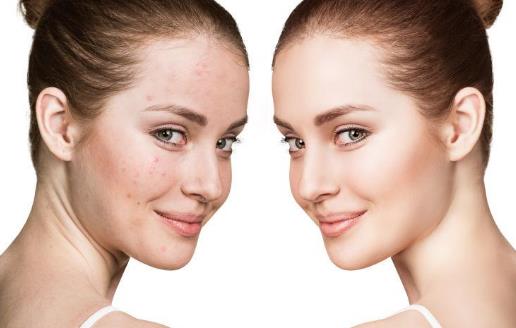 脸部经常出油的人更不健康？ 如何护理油性肌肤