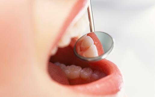 牙龈发炎肿痛怎么办 养出健康口腔少不了六必治