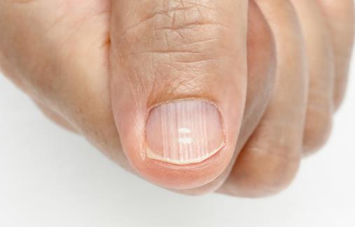 指甲凹陷的日常护理方法 指甲与疾病的预测关系