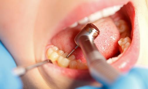 蛀牙疼痛难受 引发蛀牙的5个原因