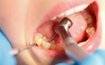 不良卫生习惯引发蛀牙疼痛难受 预防蛀牙的食物推荐