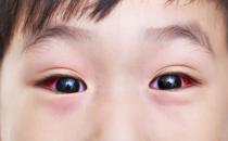 ​眼睑肿胀是红眼病的症状 预防红眼病多吃解毒食物