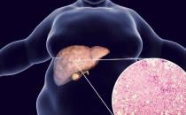脂肪肝是把软刀子 即使不胖肝脏可能早已被脂肪包围