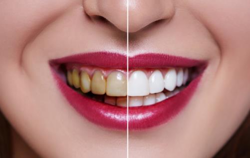 牙齿发黄到底是怎么回事？4个妙招帮你消除牙齿发黄！