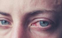 导致红血丝过多的原因 眼睛红血丝需多冷敷眼部降温
