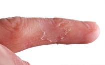 ​造成手部脱皮的原因 预防手脱皮日常需要做的保养
