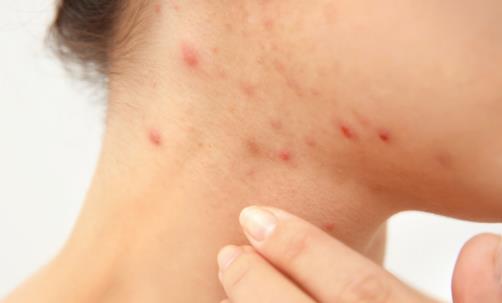 敏感性皮肤问答篇 皮肤过敏的十种防治措施
