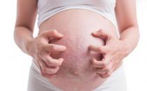 ​妊娠纹引发引发皮肤出疹 孕期如何改善和预防妊娠纹 