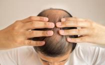 ​头发少学会科学地保养头发 预防脱发的秘诀