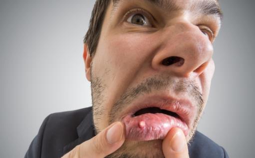 口腔溃疡的认识误区 能缓解口腔溃疡的水果