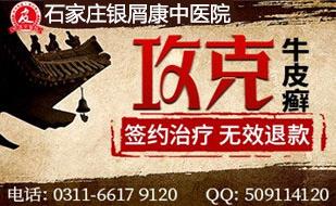 石家庄银屑康皮肤病中医院-头皮牛皮癣症状会消失吗