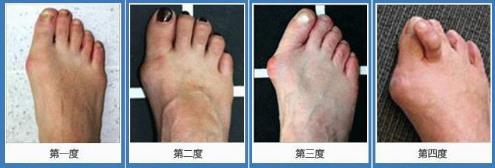 北京京医中医医院治疗拇外翻效果好吗 治疗安全有效有保障