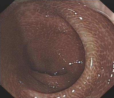 武汉汉西博仕肛肠医院：长期喝清肠茶 警惕结肠黑变病