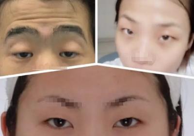 内眦赘皮怎么做效果好——北京彤美整形医院刘风卓