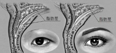 内眦赘皮怎么做效果好——北京彤美整形医院刘风卓