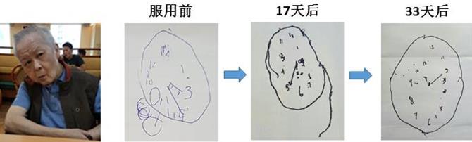 新加坡『脑复生』：改善老年痴呆的新希望
