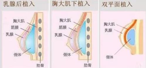 北京韩啸医生：为什么假体隆胸手术之后胸部疼痛