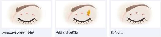 北京彤美整形医院刘风卓：双眼皮手术恢复需要多久