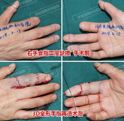济南显微外科医院 黄威手指再造怎么样 有真实的手术案例吗