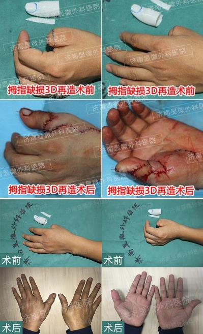 济南显微外科医院 黄威手指再造怎么样 有真实的手术案例吗
