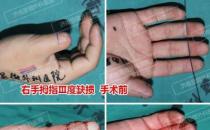 济南显微外科医院 黄威手指再造怎么样 有真实的手术案例吗