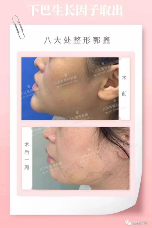 八大处整形郭鑫教授：下巴注射物取出需要多久