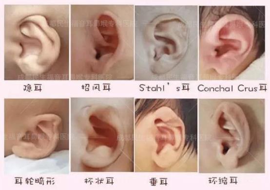 新生儿耳廓畸形能矫正吗？看成都民生耳鼻喉医院如何支招
