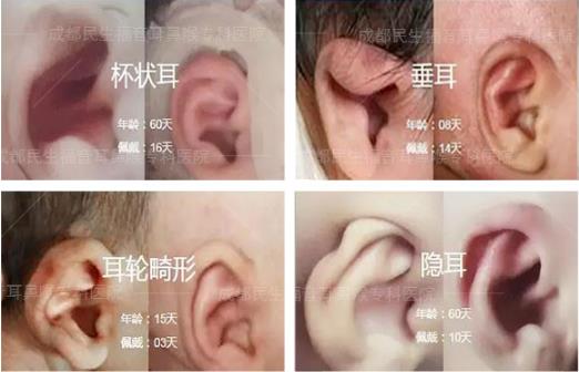 新生儿耳廓畸形能矫正吗？看成都民生耳鼻喉医院如何支招