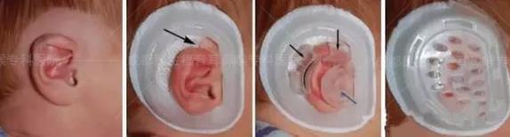 新生儿耳廓畸形能矫正吗？看成都民生耳鼻喉医院如何支招