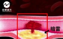 金康道夫水蛭素 轻松搞定血管堵塞 誉为“血管清道夫”