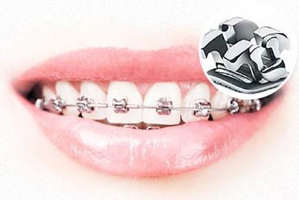 武汉德韩口腔真相大揭秘,金属矫正的过程会不会很疼?
