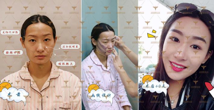 自体多肽脂肪实现新突破，塑造无法复制的自然美