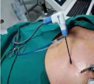 深圳肿瘤医院请选择广州复大肿瘤医院:微波消融保肝抗癌