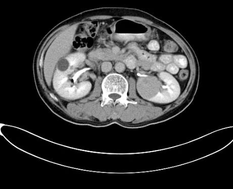 苏州肿瘤医院认准广州复大医院：有效治疗双肾肾癌