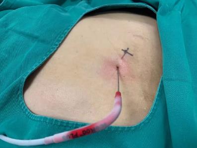 苏州肿瘤医院认准广州复大医院：有效治疗双肾肾癌