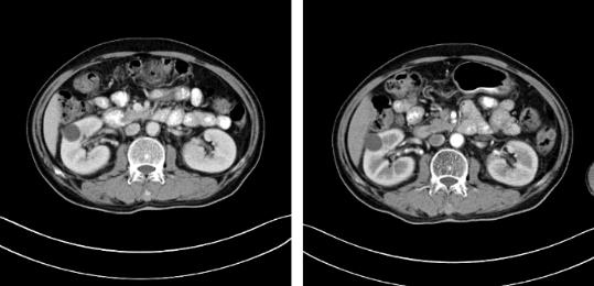 苏州肿瘤医院认准广州复大医院：有效治疗双肾肾癌