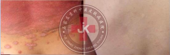 许光生：多年儿童牛皮癣终于治好，儿童牛皮癣怎么治