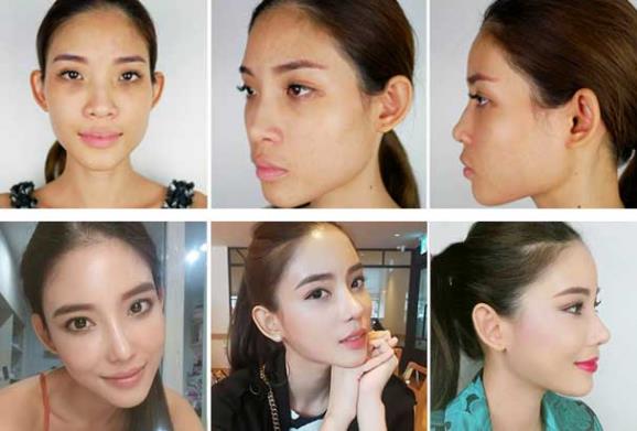 韦元强讲解：瘦子也适合做自体脂肪填充吗？