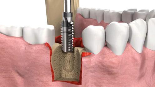 武汉做种植牙多少钱，种植牙品牌改如何选择？