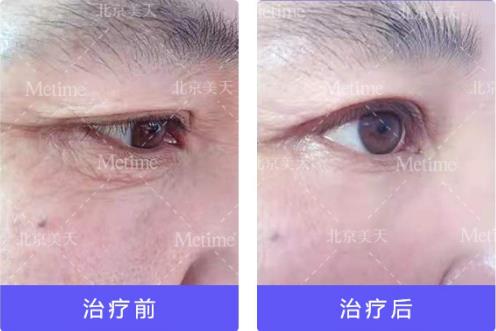 热玛吉抗衰(Thermage)官方认证中国指定操作医生—北京美天张潘院长
