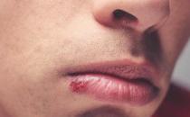​凛冬已至嘴唇总是干裂起皮发炎 冬天常见的嘴唇问题分析