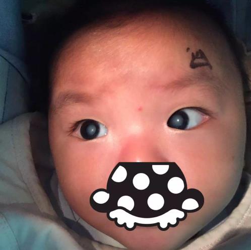 白内障手术打破年龄禁区