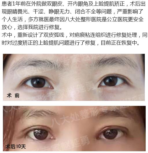 八大处整形赵延勇眼修复怎么样 用实力铸就业内口碑