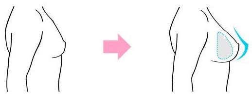 原来假体隆胸还可以这样解释！