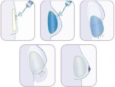 原来假体隆胸还可以这样解释！