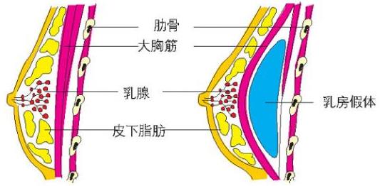 原来假体隆胸还可以这样解释！